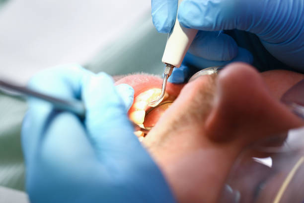 Best Emergency Dentist for Lost Fillings or Crowns in Vinton, TX